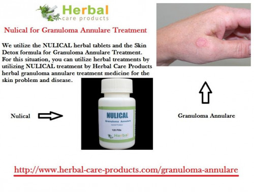 Natural Remedies for Granuloma Annulare, a chronic rash with red bumps include apple cider vinegar, Avocado Paste, Virgin Coconut Oil, Vitamin E, Green Tea, Green Tea, Herbal Oils Ginger Margosa and Milk of Magnesia. Natural Treatment for Granuloma Annulare is given below.
https://www.herbal-care-products.com/blog/10-natural-remedies-for-granuloma-annulare/