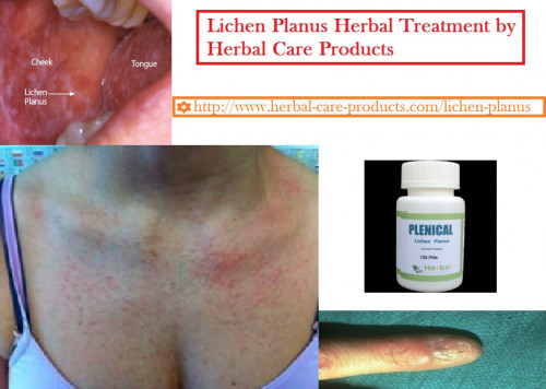 Natural Treatment for Lichen Planus is often helpful in relieving itching and improving the appearance of the rash until it goes away. The goal of the treatment is to reduce your symptoms and speeds healing of the skin lesions. Following are the some Natural Treatment for Lichen Planus given below:
https://www.herbal-care-products.com/blog/10-natural-remedies-for-lichen-planus/