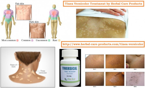 Tinea Versicolor Natural Treatment at home by Herbal Remedies. Tinea Versicolor Symptoms, Skin Fungus patches Causes, etc. Cure of fungal infection rash disease is Tiversical for patients.
https://www.herbal-care-products.com/tinea-versicolor