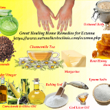 16-Great-Healing-Home-Remedies-for-Eczema