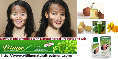 Advantages-of-Natural-and-Herbal-Remedies-or-Herbal-Oil-for-Vitiligo-Natural-Treatment.jpg