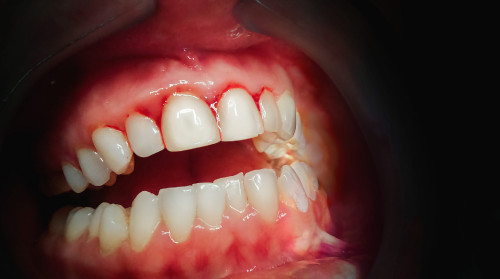 BLEEDING-GUMS-CAUSES.jpg