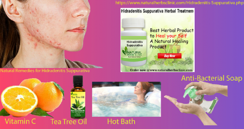 Neem oil used in Natural Remedies for Hidradenitis Suppurativa has long been used to treat skin conditions like Hidradenitis Suppurativa and acne... https://naturalherbsclinic.mystrikingly.com/blog/natural-remedies-for-hidradenitis-suppurativa