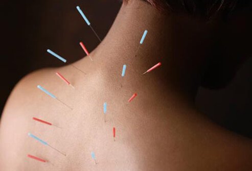 Best-Acupuncture-Doctor-In-Delhi.jpg