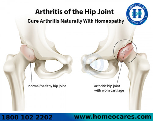 Best-Homeopathy-Treatment-For-Arthritis-Problem-In-Davangere.jpg