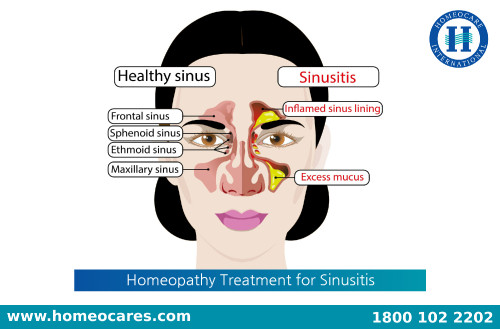 Best-Homeopathy-Treatment-For-Sinusitis-In-Mysore.jpg