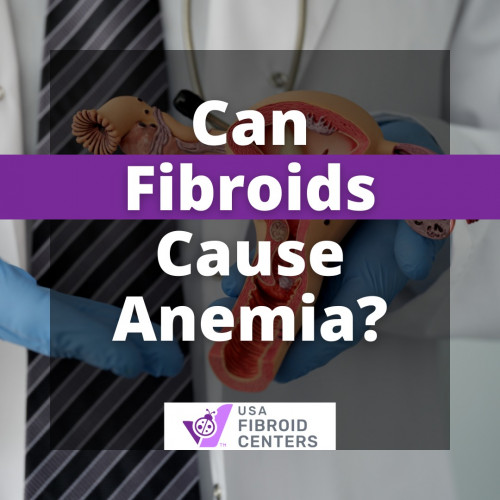 Can-Fibroid-Cause-Anemia.jpg