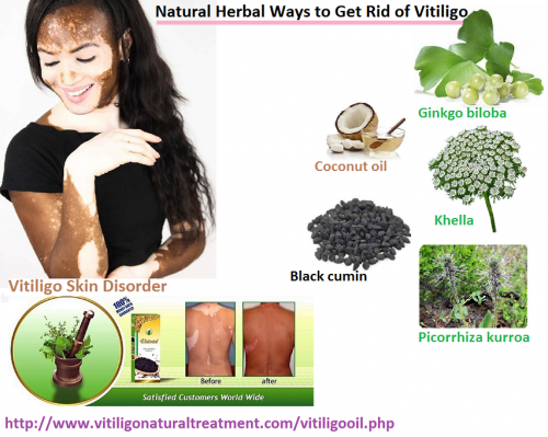 Causes-Symptoms-and-Natural-Herbal-Ways-to-Get-Rid-of-Vitiligo.png