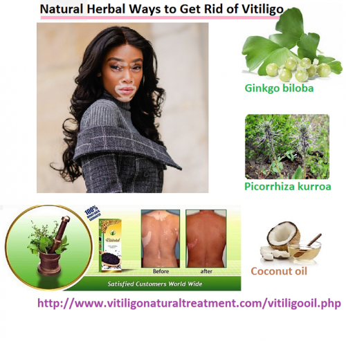 Causes-Symptoms-and-Natural-Herbal-Ways-to-Get-Rid-of-Vitiligo75a966ce0b8500aa.png