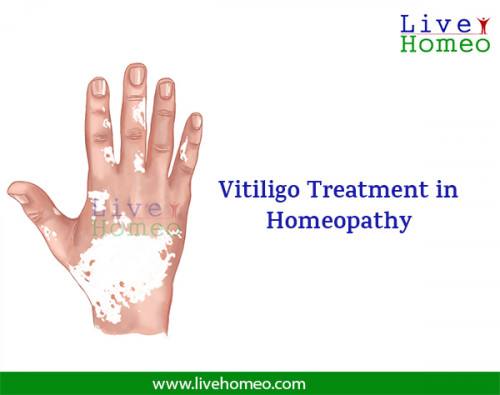 Cure-for-vitiligo-in-homeopathy.jpg