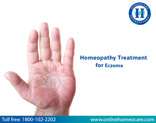 Eczema-Homeopathic-Treatment.jpg