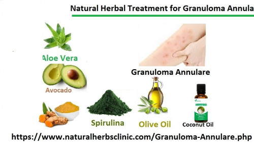 Green Tea is another one of the well-known herbal remedies for the Herbal Treatment for  Granuloma Annulare . It is an extremely rich source of antioxidants in the shape of flavonoids named catechins... https://granulomaannularecauses.blogspot.com/2015/10/informatics-article-for-patients-to.html