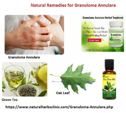 There are numerous herbs using Natural Remedies for Granuloma Annulare that can recover skin issues such as oak leaf extract which has remedial properties for skin... https://granulomaannularecauses.blogspot.com/2015/10/informatics-article-for-patients-to.html