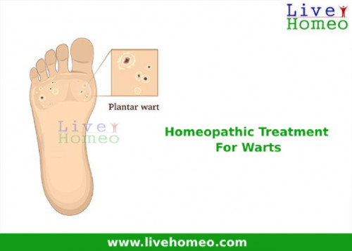 Effective-Homeopathy-Treatment-For-Warts_1.jpg