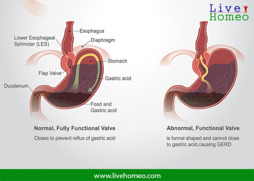 GERD-Is-Curable-By-Homeopathy.jpg