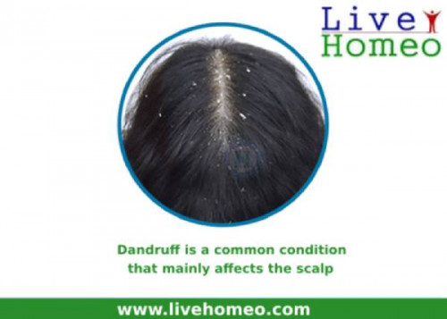 Get-Rid-Of-Dandruff-With-Homeopathy-_.jpg