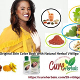 Get-Your-Original-Skin-Color-Back-with-Natural-Herbal-Vitiligo-Treatment-Method