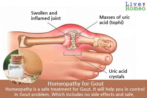 Gouty-Arthritis.jpg