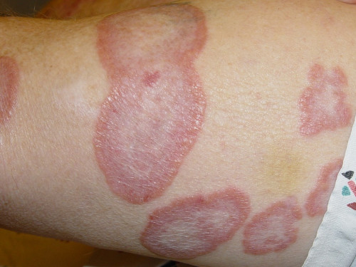 Granuloma-Annulare--Auto-Immune-Skin-Disorder.jpg