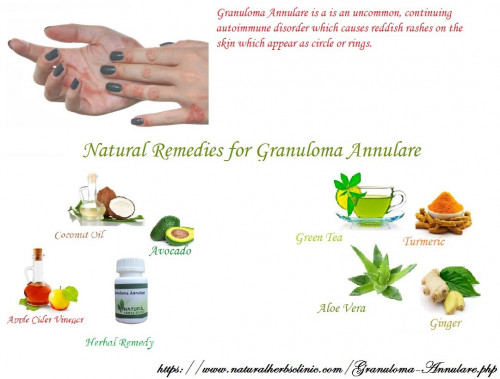 Now you know the possible causes and symptoms of granuloma annulare. If you are observing any of these symptoms, make sure if you have GA. If sure, you may try the following Natural Herbal Treatment for Granuloma Annulare skin infection... https://naturalcureproducts.wordpress.com/2014/01/21/granuloma-annulare-causes-symptoms-diagnosis-treatment/