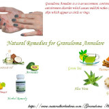 Granuloma-Annulare-and-its-Treatment-with-Natural-and-Herbal-Remedies