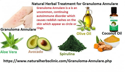 In clearer and shorter words our Herbal Treatment for Granuloma Annulare formulated to fight the symptoms of Granuloma Annulare is one of the best Natural Treatment for Granuloma Annulare so far because it has no side effects connected with it and the ingredients used in the formula are purely natural... https://naturalherbsclinic.sitelio.me/granuloma-annulare/6-natural-herbal-treatments-for-granuloma-annulare-skin-disorder/