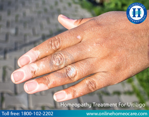 Homeopathic-Treatment-For-Vitiligo.jpg