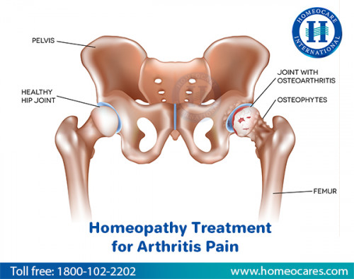 Homeopathy-Treatment-For-Arthritis.jpg