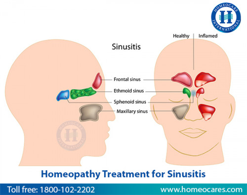 Homeopathy-Treatment-for-Sinusitis.jpg