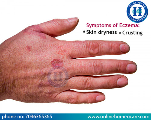 Homeopathy-treatment-for-Eczema.jpg