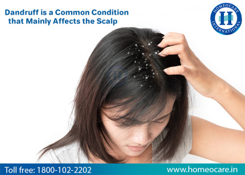 Homeopathy-treatment-for-dandruff.jpg