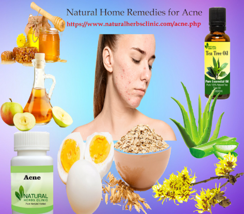 Another Natural Remedies for Acne to reduce the appearance of the condition shrink enlarged pores is to use egg whites together with tea tree oil... https://ancenaturalremedies.blogspot.com/2021/01/natural-remedies-for-acne.html