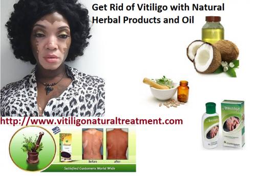 How-you-know-if-you-Have-Vitiligo-and-How-to-Get-rid-of-it-naturally.png