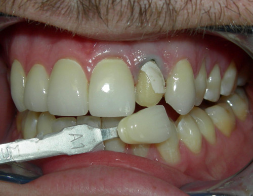 Most-Important-Facts-You-Should-Know-About-Dental-Crowns.jpg