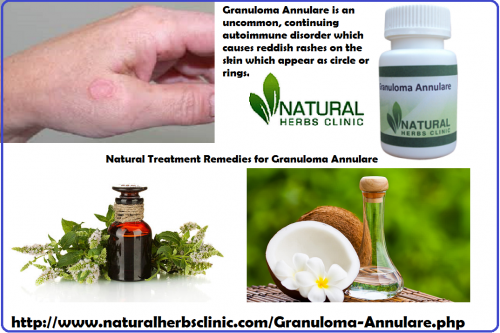 Granuloma Annulare Herbal Treatment includes DMSO, apple juice vinegar connected topically and taken orally, milk of magnesia, lysine and tannic corrosive. In addition, vitamin E, Tea Tree oil, and green tea also help in treatment and serve as a Granuloma Annulare Natural Treatment and a treatment for skin inflammation.... https://www.chaino.com/pulse/granuloma-annulare-herbal-treatment-includes-dmso-apple-juice-vinegar-connected