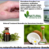 Natural-Herbal-Remedies-and-Oil-for-Granuloma-Annulare-Herbal-Treatment