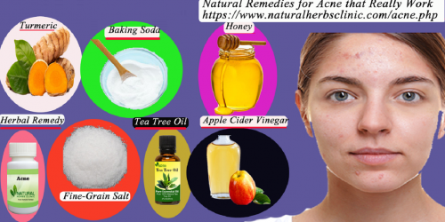 Holecek says honey is one of the soothing Natural Remedies for Acne scars. For a DIY facial, she recommends mixing honey, aloe vera, one teaspoon of chickpea flour, and a pinch of turmeric to make a paste.... https://naturalherbsclinic.bcz.com/natural-remedies-for-acne/