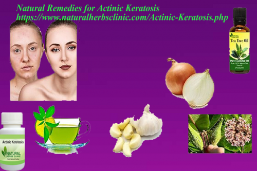 Actinic keratosis is a type of skin disease is caused by too much exposure to the sun. In this contagion, tiny patches of scaly skin occur on the neck, ears, face, forearms, and scalp. Natural Herbs Clinic is an online herbal store that provides Natural Remedies for Actinic Keratosis to get relief... https://www.naturalherbsclinic.com/Actinic-Keratosis.php