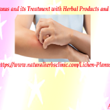 Natural-Remedies-for-Lichen-Planus