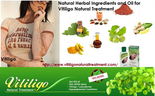 Natural-Treatment-of-Vitiligo.jpg