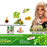 Natural-and-Herbal-Treatment-for-Vitiligo-Skin-Spots