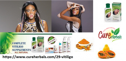 Naturally-Healing-of-Vitiligo.png