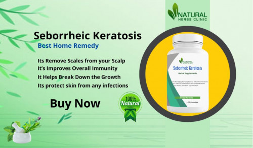 Seborrheic-Keratosis-and-How-to-Treat-it-with-Natural-Remedies.jpg