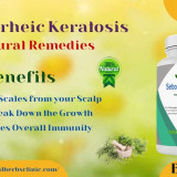 Skin-Damage-with-Seborrheic-Keratosis-Utilize-Natural-Treatments-to-Get-Relief