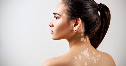 Skin-Vitiligo-Natural.jpg