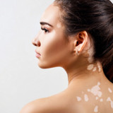 Skin-Vitiligo-Natural