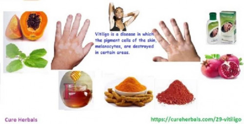 Skin-Vitiligo-Organics.jpg