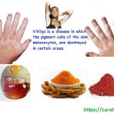 Skin-Vitiligo-Organics