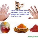 Skin-Vitiligo-Organics3706634e446cca59