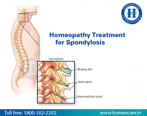 Degenerative changes in the spine is referred as Spondylosis or Spinal Osteoarthritis. Cervical spondylosis, Lumbar spondylosis, Thoracic spondylosis, Lumbosacral spondylosis and Multilevel spondylosis are different types of spondylosis. Factors like aging, injuries, congenital abnormalities, poor posture, malnutrition and several others trigger the risk of spondylosis. Homeocare International treats Spondylosis effectively using Constitutional Homeopathy. It does not just aim to control symptoms but also halts further degeneration of discs..For more detailsplsvisit http://www.homeocare.in/homeopathy-spondylosis-treatment.html toll free no:1800-102-2202
address:
Near JNTU X Road, Towards Hi Tech City Road,
Near ICICI Bank, Beside HDFC Bank,
K.P.H.B, Hyderabad-500072,
Telangana, INDIA